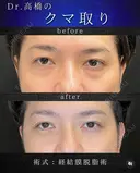 目の下のクマ取り(脱脂術) after画像 サムネイル用