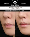 鼻下切開人中短縮・小鼻縮小・鼻翼挙上 before画像 サムネイル用