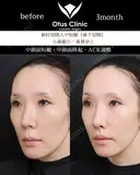 鼻下切開人中短縮・小鼻縮小・鼻翼挙上 90日後 サムネイル用
