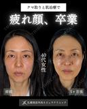 横田開DRによる🌟クマ取り×シミ取り🌟 before画像 サムネイル用