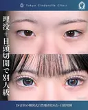 目頭切開/韓国式自然癒着法6点 30日後 サムネイル用