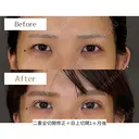 二重全切開修正＋目上切開 30日後 サムネイル用