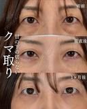 横田開DRによる🌟クマ取り×糸リフト×目の下のヒアルロン酸🌟 after画像 サムネイル用