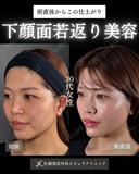 横田開DRによる🌟糸リフト×顎ヒアルで下顔面若返り🌟 before画像 サムネイル用