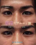 涙袋ヒアルロン酸 before画像 サムネイル用