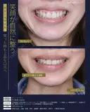 【40代女性・歯茎の露出を調整】ガミースマイル（3ヶ月後） before画像 サムネイル用