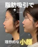 頬・顎下脂肪吸引 89日後 サムネイル用