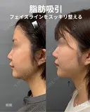 頬・顎下脂肪吸引 before画像 サムネイル用