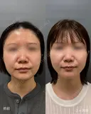頬・顎下脂肪吸引 after画像 サムネイル用