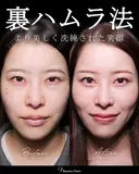 クマ治療　ハムラ法 after画像 サムネイル用