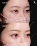クマ治療　ハムラ法 before画像 サムネイル用