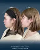 顔の脂肪吸引 60日後 サムネイル用