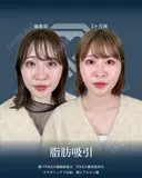顔の脂肪吸引 before画像 サムネイル用