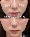 ゴルゴヒアルロン酸 before画像 サムネイル用