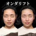オンダリフト after画像 サムネイル用