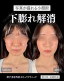 岩﨑先生による🔥小顔整形🔥 before画像 サムネイル用