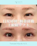 目尻切開＋靭帯移動＋上眼瞼リフト｜目力アップ✨ after画像 サムネイル用
