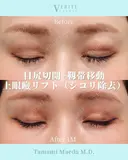 目尻切開＋靭帯移動＋上眼瞼リフト｜目力アップ✨ after画像 サムネイル用
