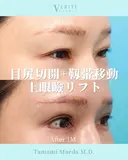 目尻切開＋靭帯移動＋上眼瞼リフト｜目力アップ✨ after画像 サムネイル用
