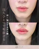 Ｃカールリップ（ボルベラ1cc）+顎（ボラックス1cc） after画像 サムネイル用