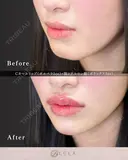 Ｃカールリップ（ボルベラ1cc）+顎（ボラックス1cc） after画像 サムネイル用