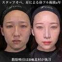 術後2年 耳による鼻中隔延長、耳介軟骨移植、鼻尖形成、猫手術、わし鼻切除、骨切り幅寄せ 720日後 サムネイル用