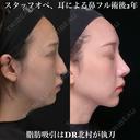 術後2年 耳による鼻中隔延長、耳介軟骨移植、鼻尖形成、猫手術、わし鼻切除、骨切り幅寄せ 72日後 サムネイル用