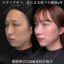 術後2年 耳による鼻中隔延長、耳介軟骨移植、鼻尖形成、猫手術、わし鼻切除、骨切り幅寄せ 720日後 サムネイル用