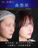 鼻尖形成・鼻プロテーゼ・小鼻縮小・耳珠軟骨移植 after画像 サムネイル用