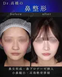 鼻尖形成・鼻プロテーゼ・小鼻縮小・耳珠軟骨移植 before画像 サムネイル用