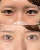 アリエルクイックループ（二重埋没法） before画像 サムネイル用