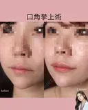 口角挙上術 after画像 サムネイル用