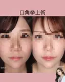 口角挙上術 before画像 サムネイル用