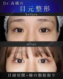 目頭切開・瞼の脂肪取り after画像 サムネイル用