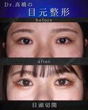 目頭切開 after画像 サムネイル用