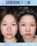 目頭切開・二重埋没法(自然癒着法) after画像 サムネイル用