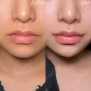 口唇整形－複合－ after画像 サムネイル用