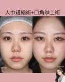 人中短縮術・口角挙上術 before画像 サムネイル用