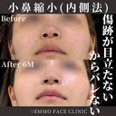 鼻翼縮小 (内側法) 180日後 サムネイル用