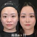 術後6ヶ月 北村医師とコラボオペ before画像 サムネイル用