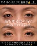 『凹み目に対する埋没法の見解』 before画像 サムネイル用