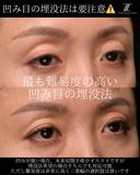 『凹み目に対する埋没法の見解』 0日後 サムネイル用