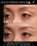 『凹み目に対する埋没法の見解』 0日後 サムネイル用