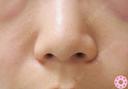 鼻翼（切開）プレミア法 before画像 サムネイル用