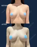 脂肪豊胸 after画像 サムネイル用
