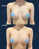 後からハイブリッド豊胸 after画像 サムネイル用