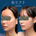 糸リフト　8本 after画像 サムネイル用