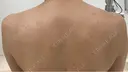 ピコートーニング before画像 サムネイル用