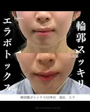エラボトックス 0日後 サムネイル用
