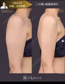 ベイザー二の腕＋肩脂肪吸引 after画像 サムネイル用